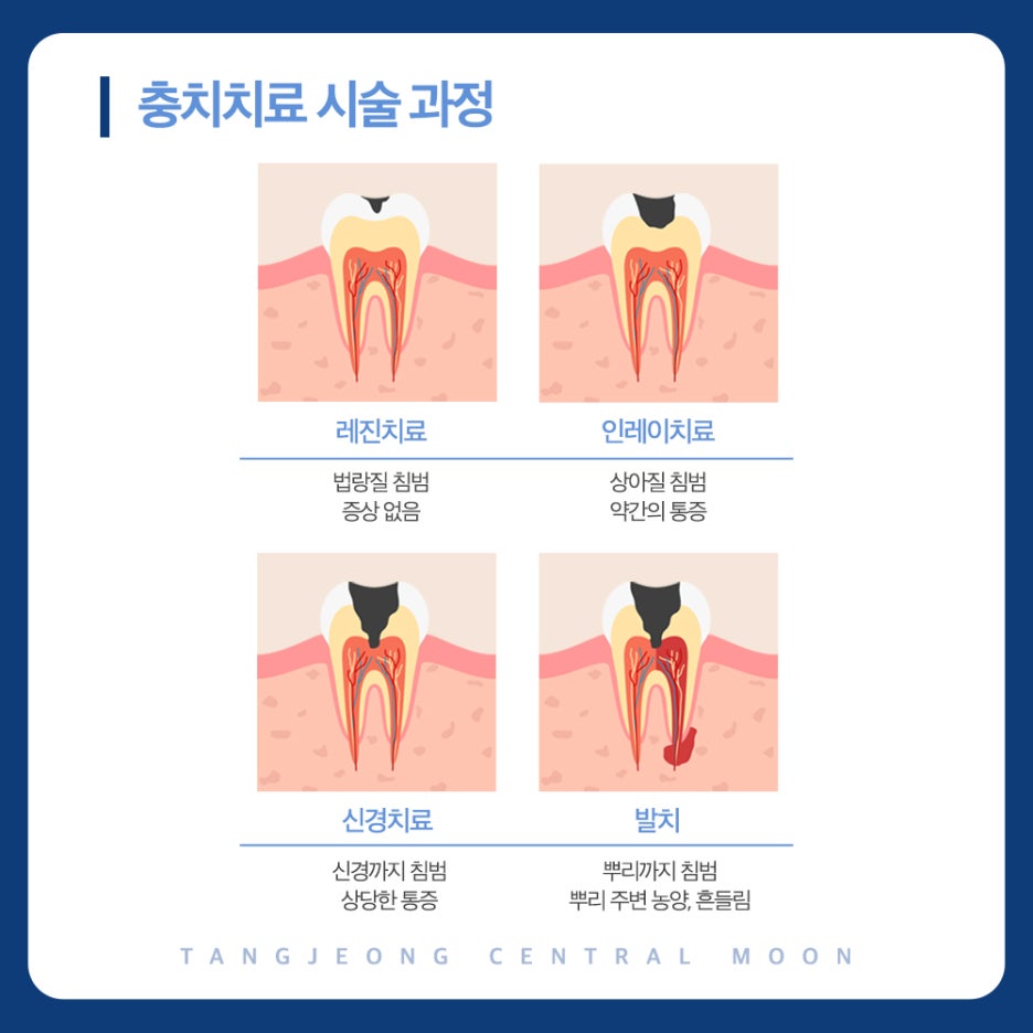 탕정충치치료